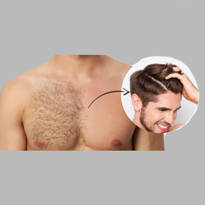 BODY HAIR TO HEAD - GAGA CLINIC - TURKEY - HAIR TRANSPLANT