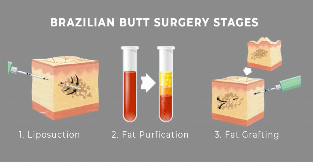 brazilian butt surgery stages - gaag clinic - turkey