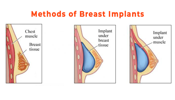breast implant method - gaga clinic - turkey