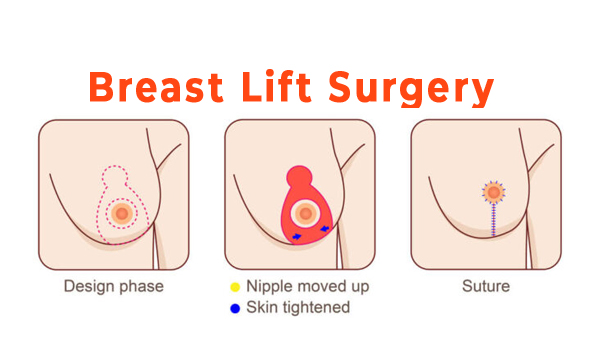 breast lift surgery - gaga clinic - turkey