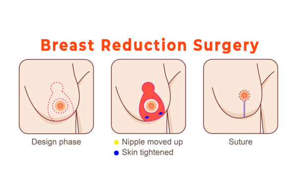 breast reduction surgery - gaga clinic - turkey